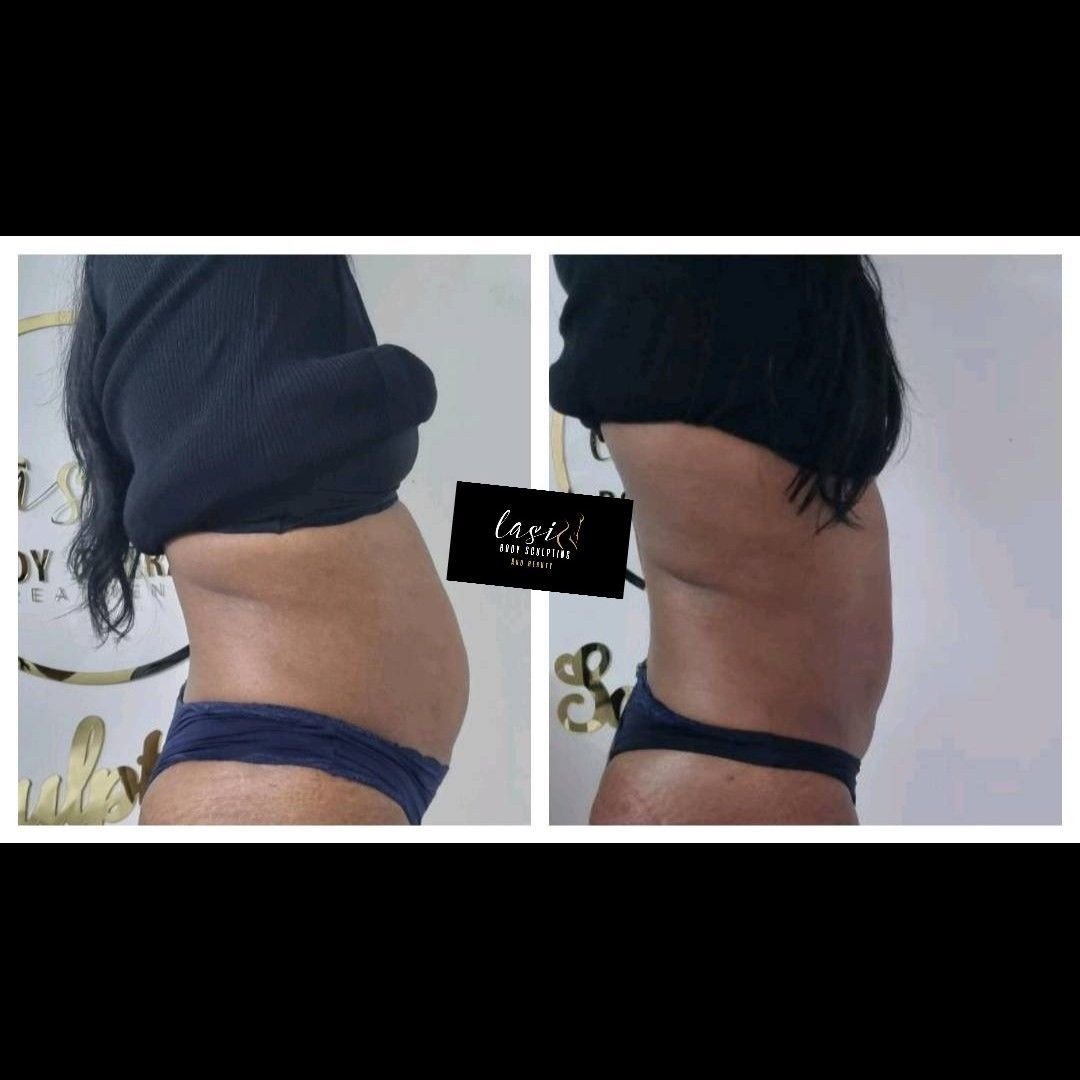 before and after mummy makeover bundle